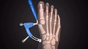 Guide viseur Pecaplasty®
