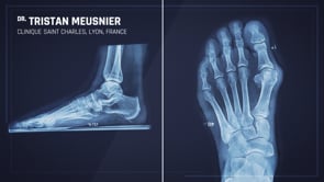 Guide viseur Pecaplasty®