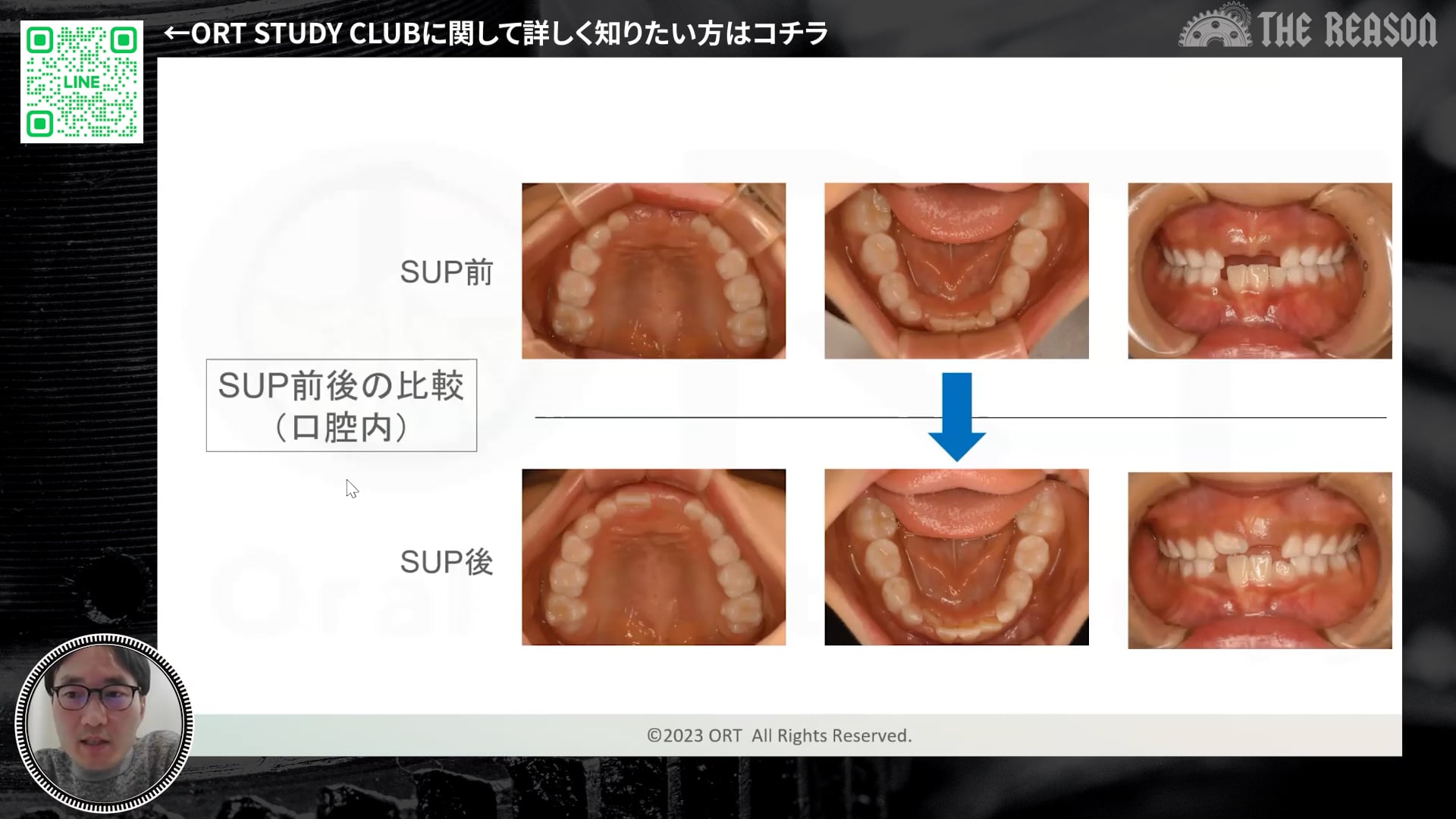 第25回 7歳児の早期脱落 原因にアプローチする口腔機能の適正化