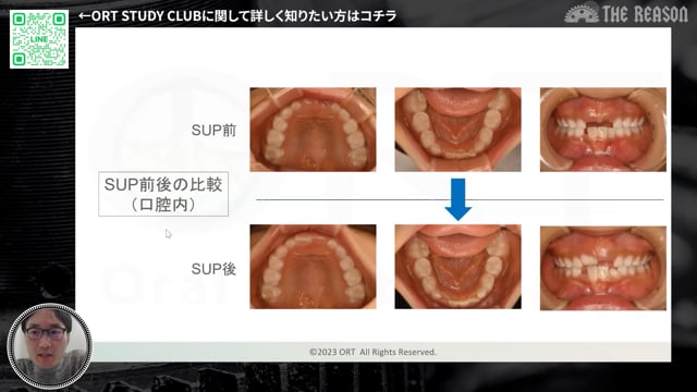 第25回 7歳児の早期脱落 原因にアプローチする口腔機能の適正化