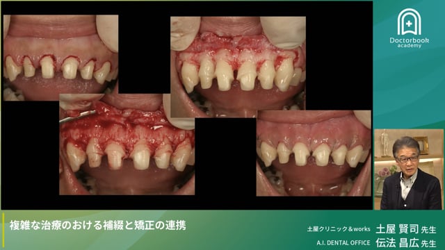 複雑な治療における補綴と矯正の連携