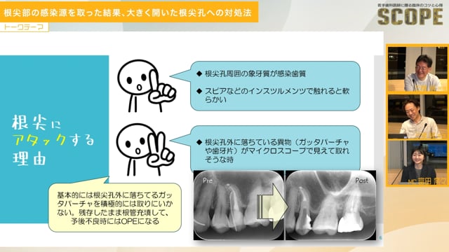 根尖部の感染源を取った結果、大きく開いた根尖孔への対処法