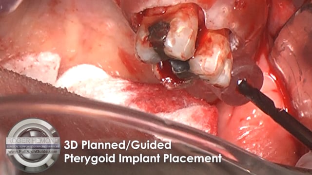 Surgery Video of 3D Planned and Guided Pterygoid Implant Placement for Remote Anchorage