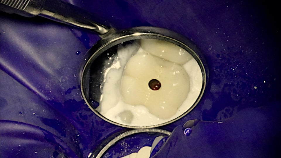 Pulp in Flux Endodontic Clinical TIp