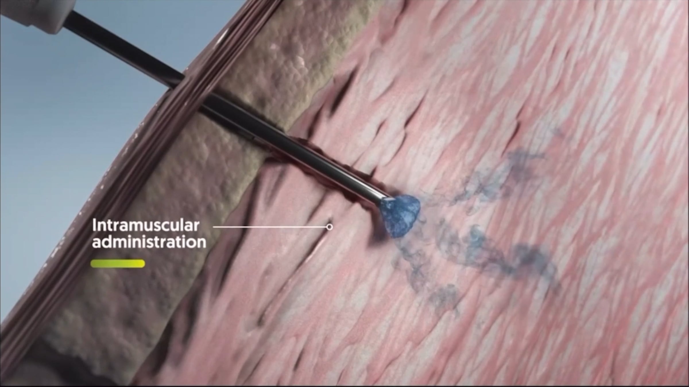 Risperidone ISM (Risvan) – A New LAI for Schizophrenia | Videos ...
