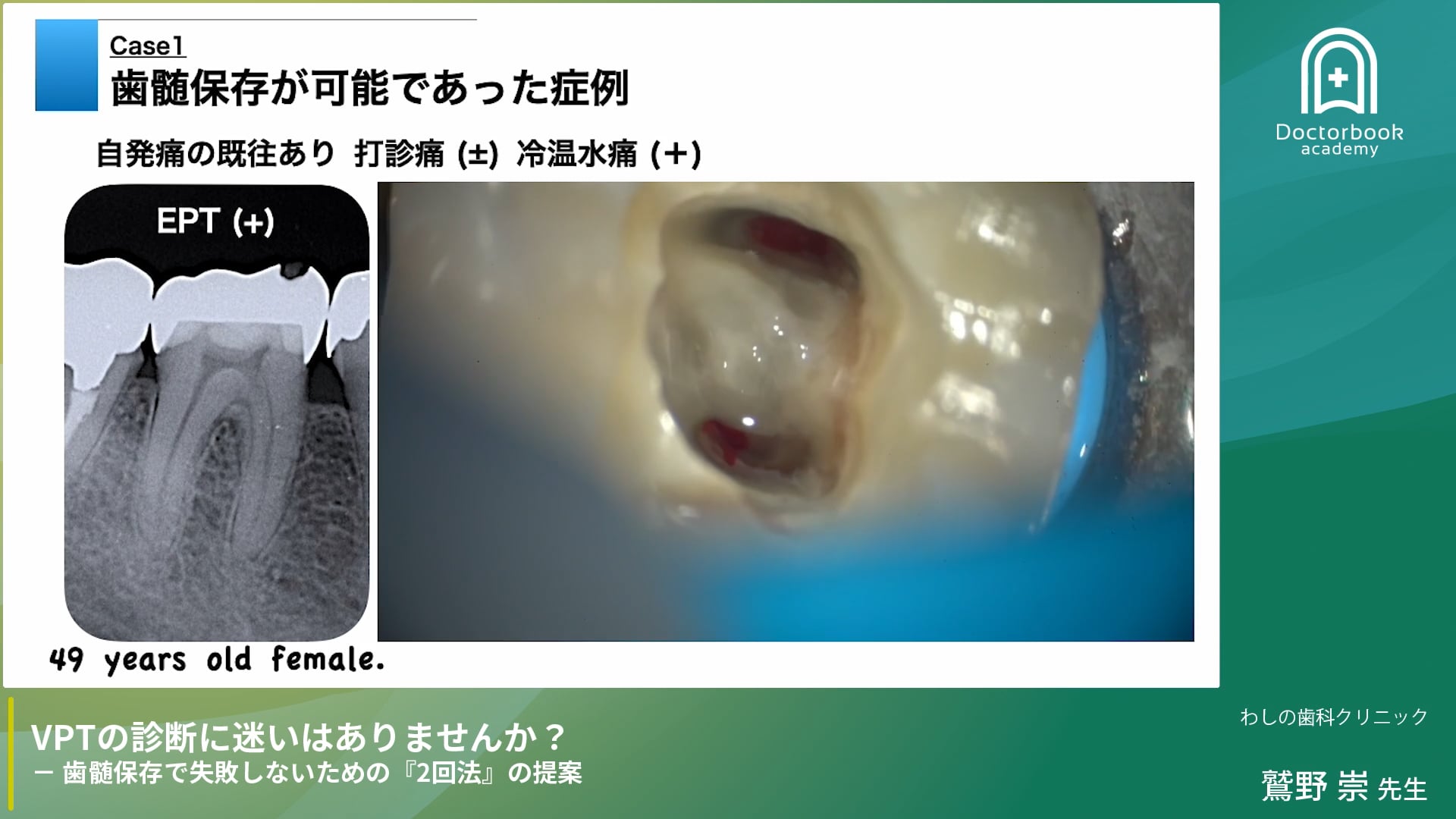 VPTの診断に迷いはありませんか？- 歯髄保存で失敗しないための『2回法』の提案 -
