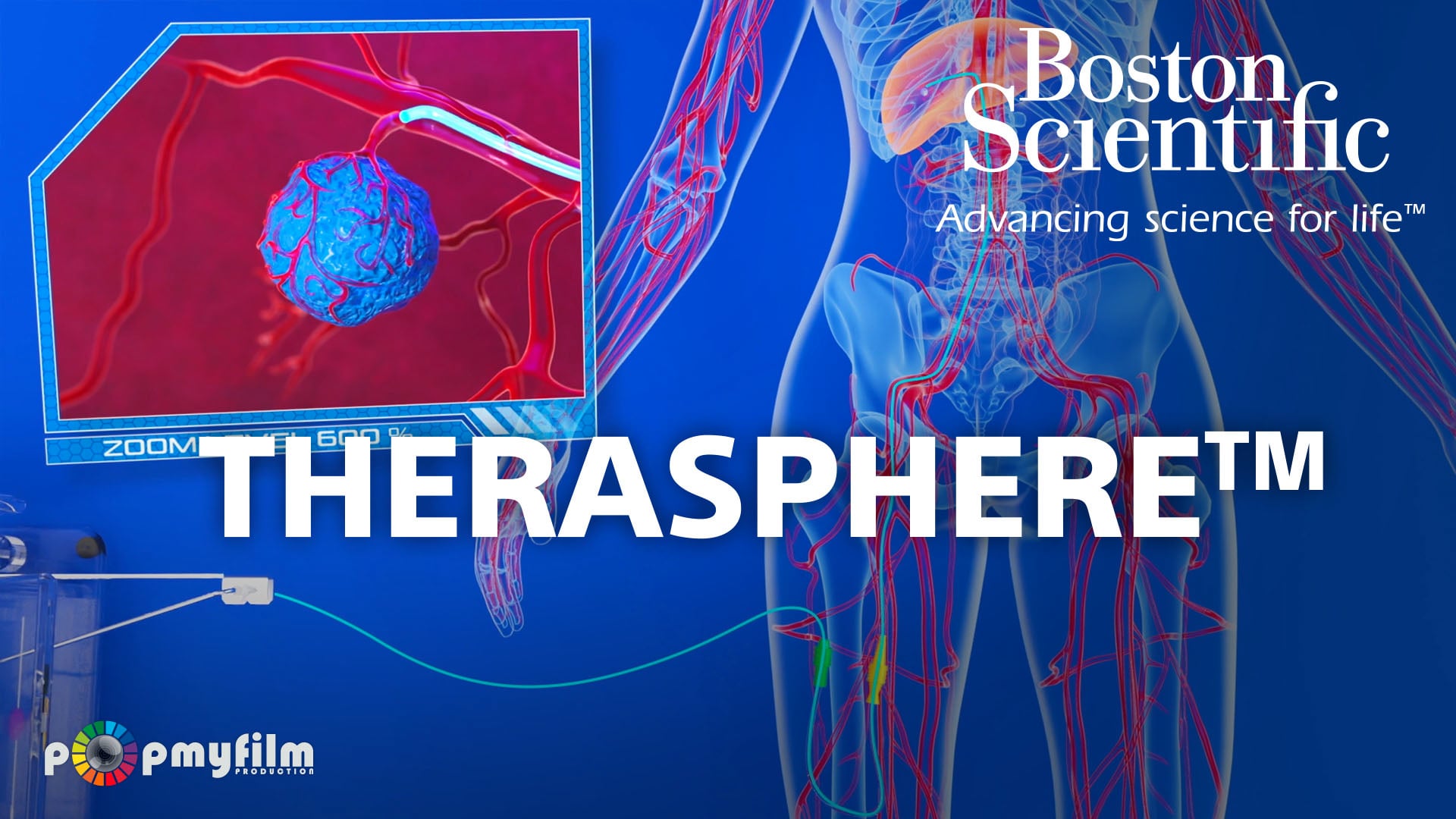 Therasphere™ – Une avancée contre le cancer du foie