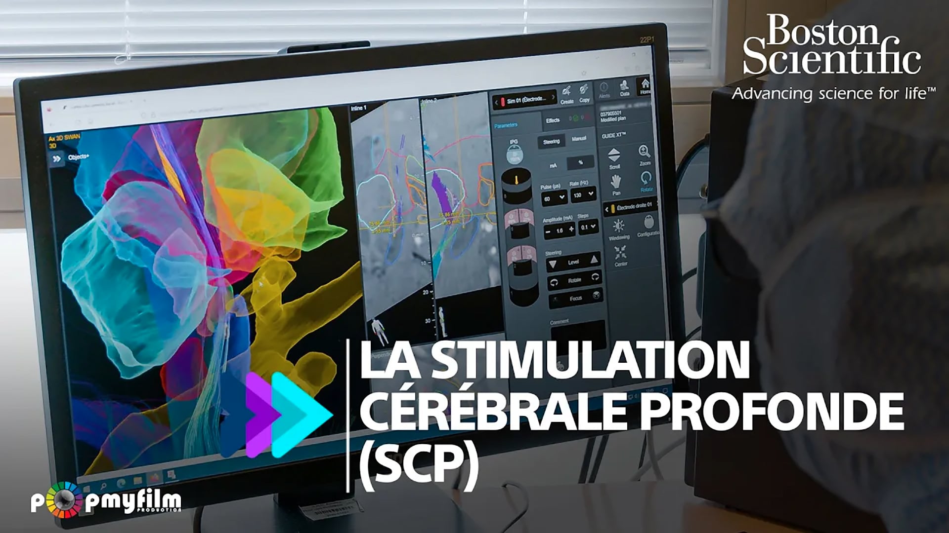 Public / Amiens / Neuro / La SCP / V1