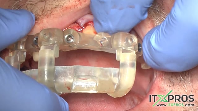 Surgery Videography Stackable Full Arch Guided System