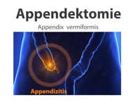 KIUNTKE_MARTIN_Erklärfilm_Appendektomie