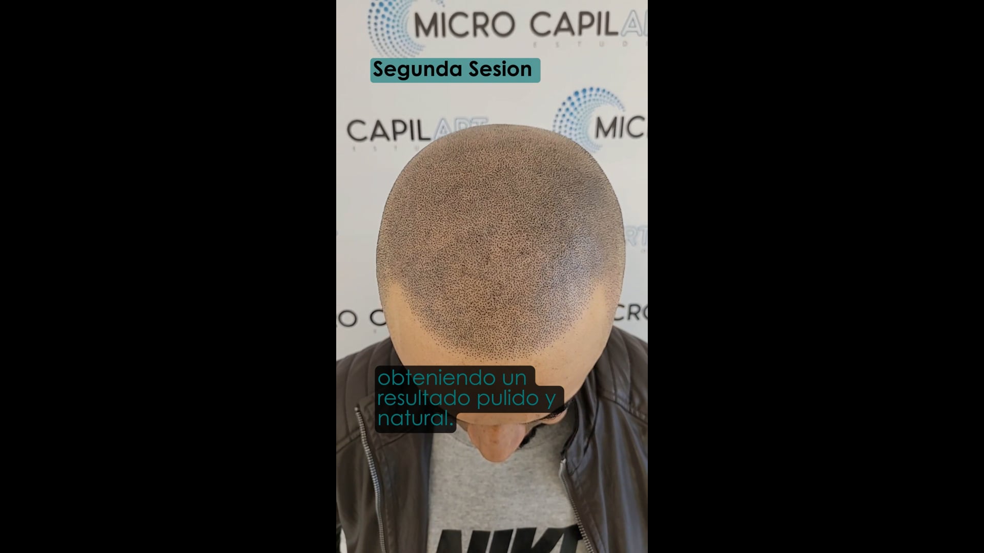 Micropigmentacion capilar paso a paso