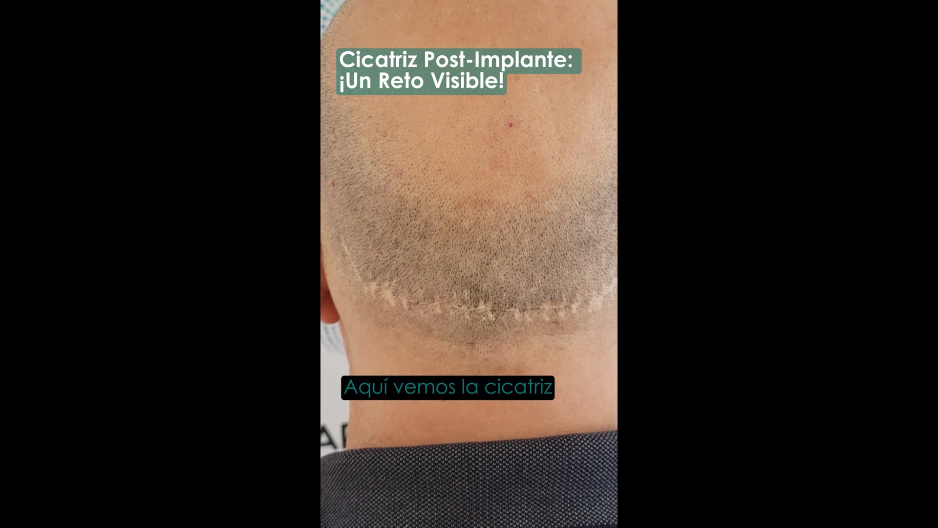 Camuflaje de cicatrices por implantes capilares
