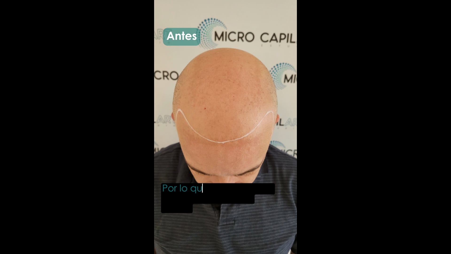 Micropigmentación Capilar: ¡Transformación COMPLETA Paso a Paso!