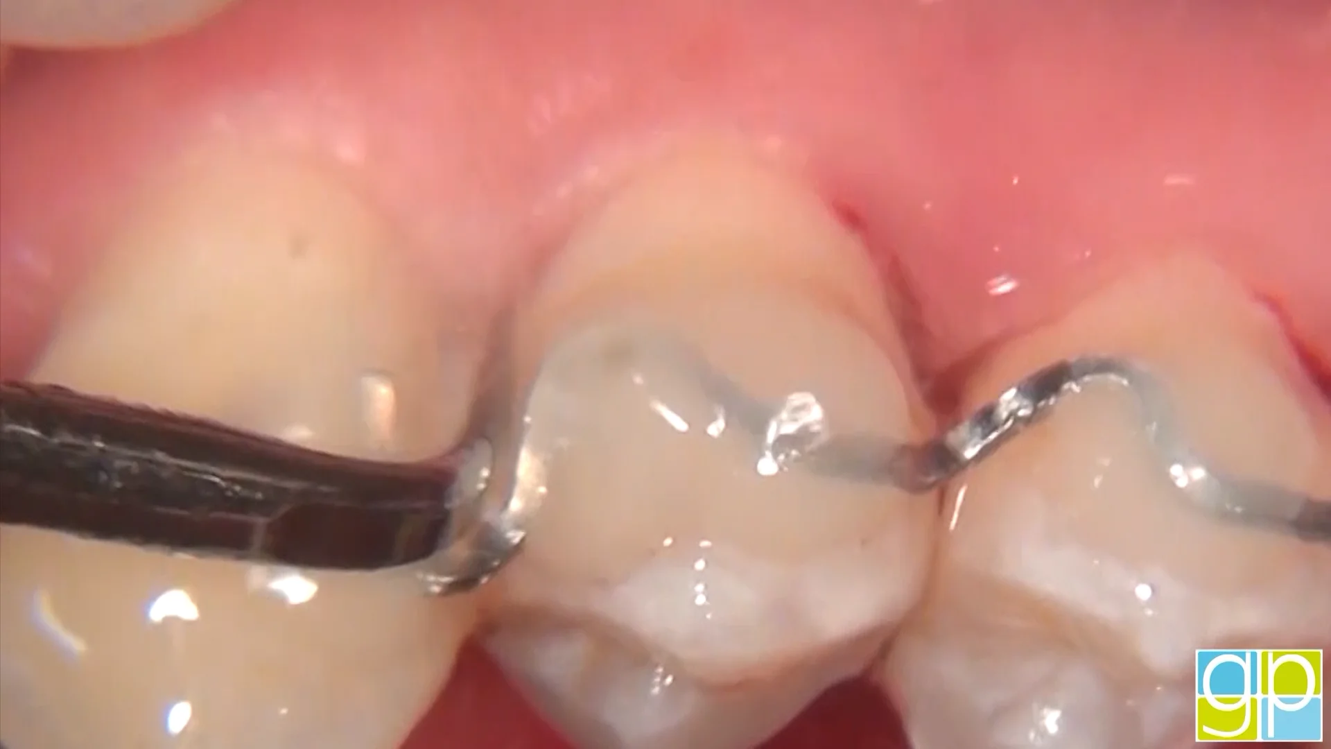 Ablatore Ad Ultrasuoni D-7 Compatibile Satelec® – Blu Dental - Foto 2