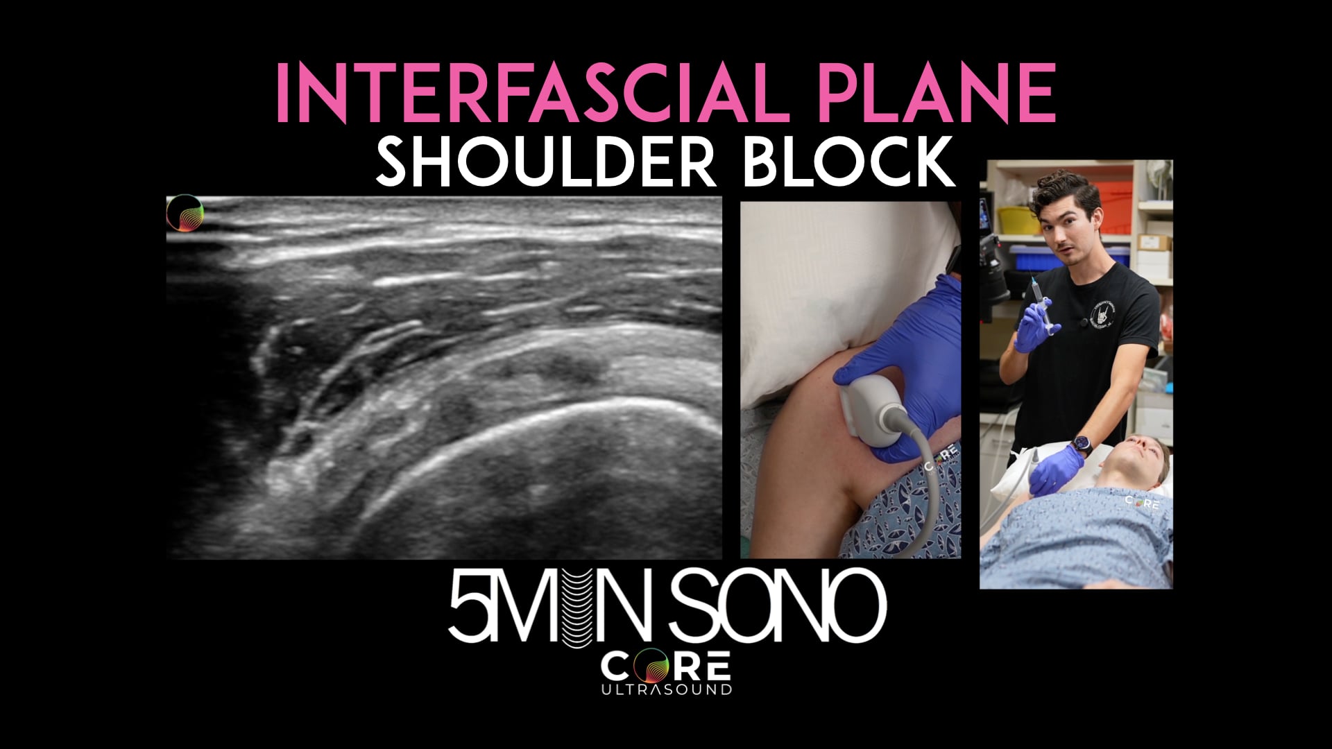 Image of 5 Min Sono – Interfascial Shoulder Plane Block
