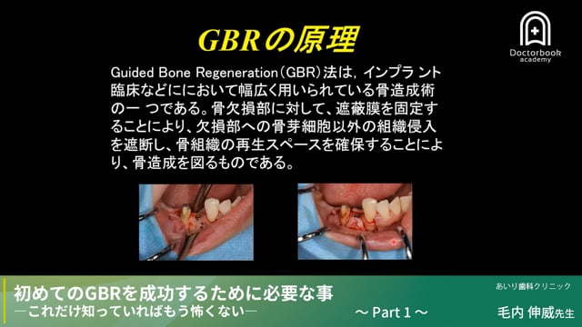 インプラント治療の根幹〜GBRとは？〜 #1