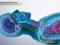 Adult Restricted Airway