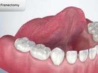 Lingual Frenectomy
