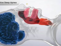 Obstructive Sleep Apnea