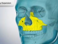 Maxillary Expansion