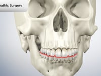 Orthognathic Surgery