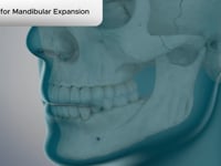 Options for Mandibular Expansion