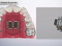 Pediatric Palatal Expander