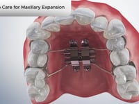 Post-op Care for Maxillary Expansion