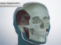 TMD Condylar Degeneration
