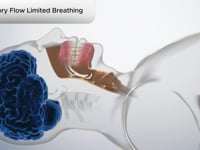 Inspiratory Flow Limited Breathing