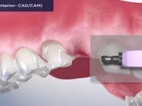 Bridge (Anterior- CADCAM)