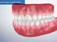 Filling Versus Crown (CADCAM)