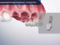 Implant-Supported Bridge (Anterior- CADCAM)