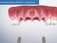 Implant-Supported Bridge (Anterior- Impression)