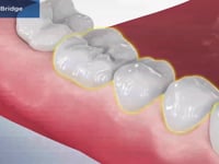 Posterior Bridge