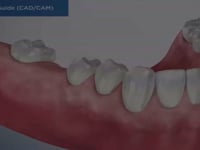 Surgical Guide (CADCAM)