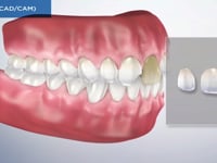 Veneers (CADCAM)