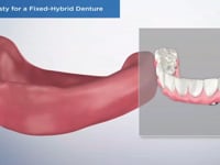 Alveoplasty for a Fixed-Hybrid Denture