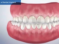 Caring for a Dental Implant