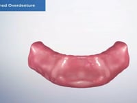 Bar Retained Overdenture
