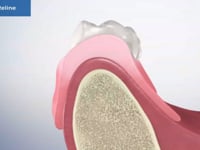 Denture Reline