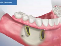 Fixed Hybrid Dentures