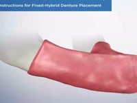 Post-Op Instructions for Fixed-Hybrid Denture Plac