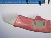 Post-Operative Instructions for a Bar-Retained Ove