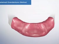 Locator Retained Overdenture (Reline)