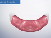 Locator Retained Overdenture