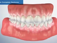 Removable Complete Dentures