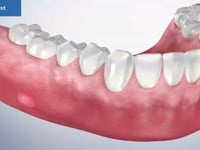 Dental Cyst