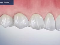 Elective Root Canal