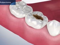 Pediatric Pulpectomy